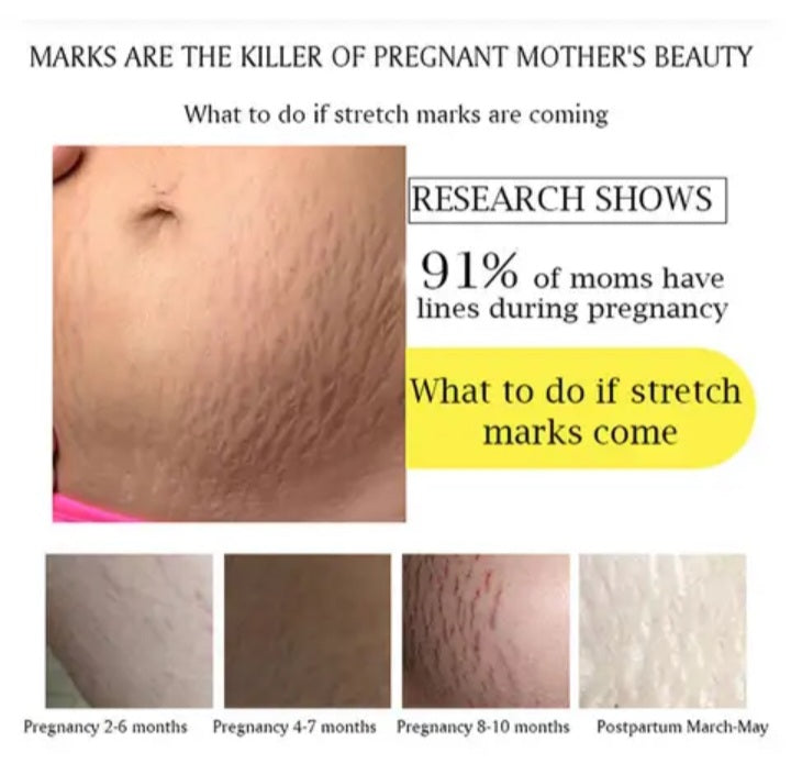 Stretch Mark remover cream,ANTI wrinkle  skin repair  Firming Skin Stretch Mark Removal Cream