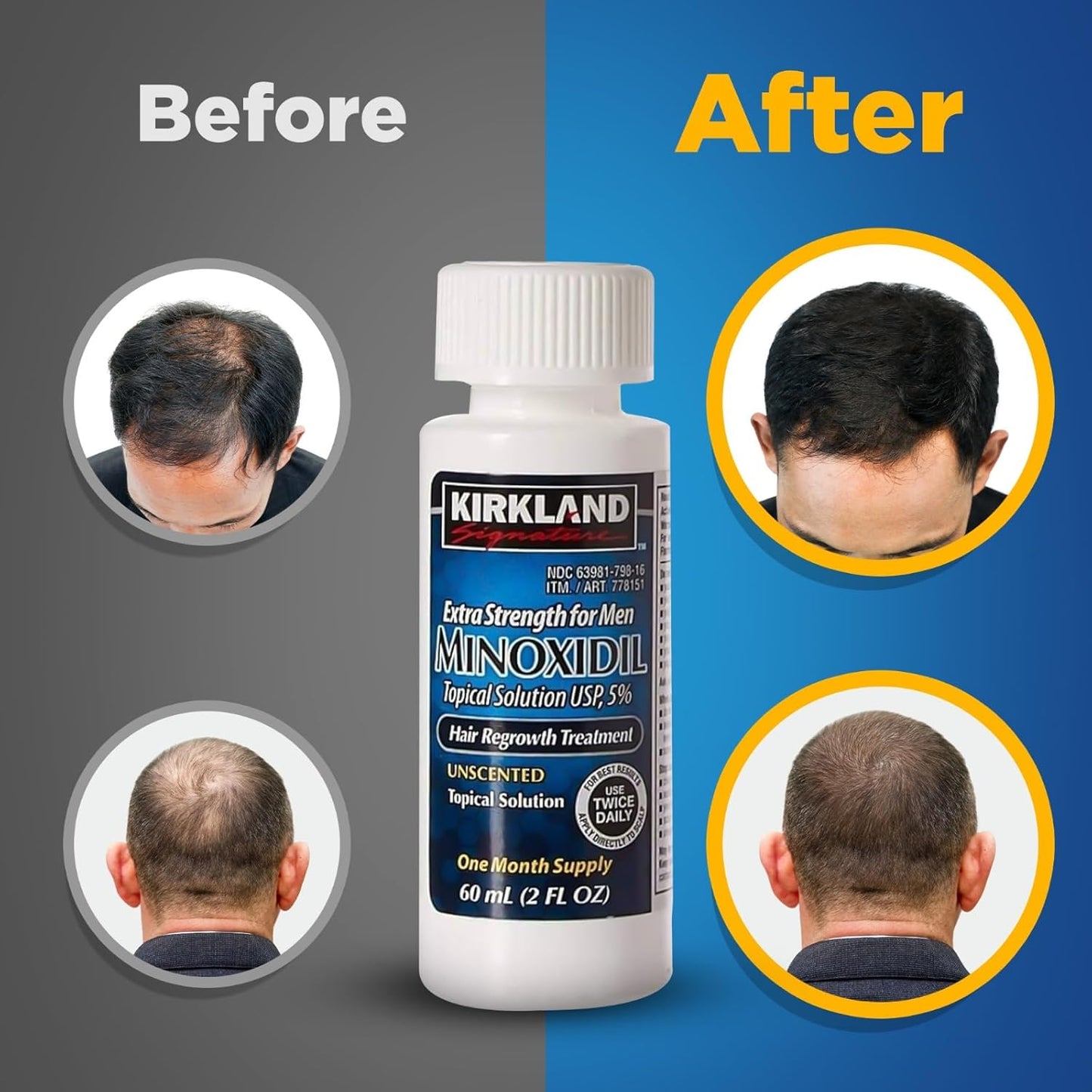 Kirkland Minoxidil  Hair Loss Regrowth Revitalizes Hair Follicles 5% Minoxidil Topical Solution  (60 Ml) Original 1 month supply