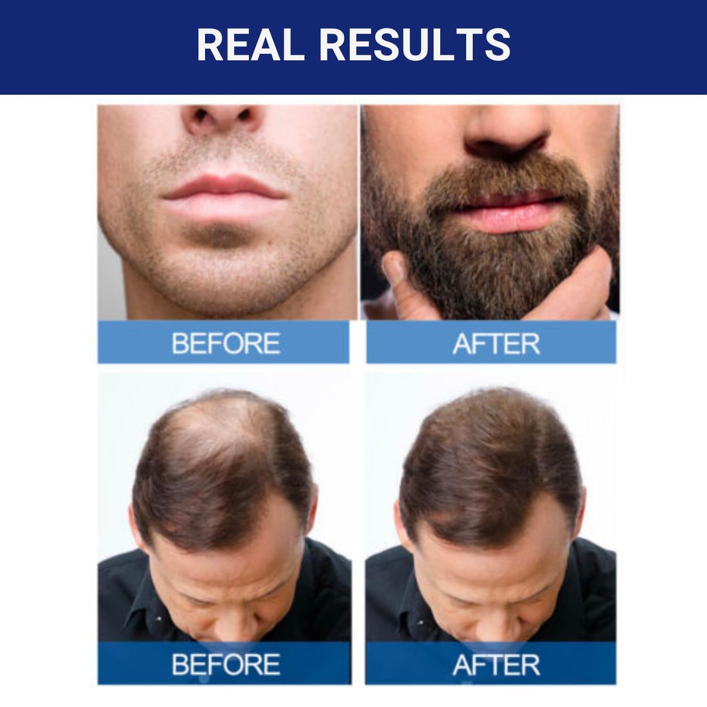 Kirkland Minoxidil  Hair Loss Regrowth Revitalizes Hair Follicles 5% Minoxidil Topical Solution  (60 Ml) Original 1 month supply